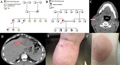 Dominant-negative signal transducer and activator of transcription (STAT)3 variants in adult patients: A single center experience